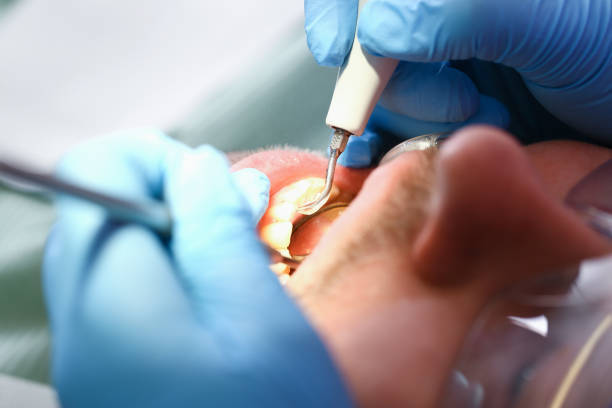 Best Emergency Treatment for Dental Infections or Abscesses in Buellton, CA