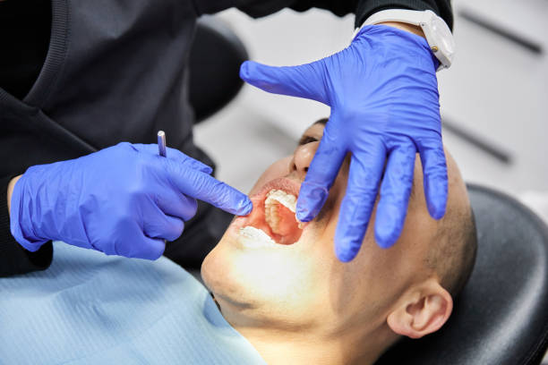Best Emergency Wisdom Teeth Removal in Buellton, CA